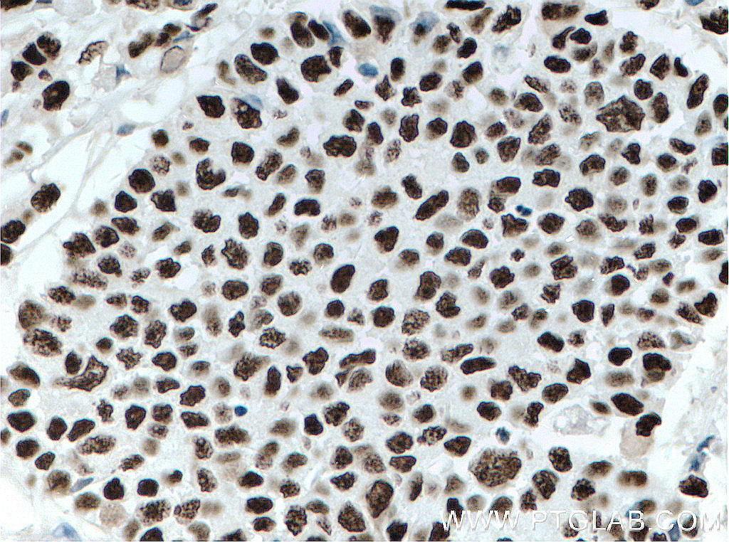 IHC staining of human colon cancer using 66630-1-Ig