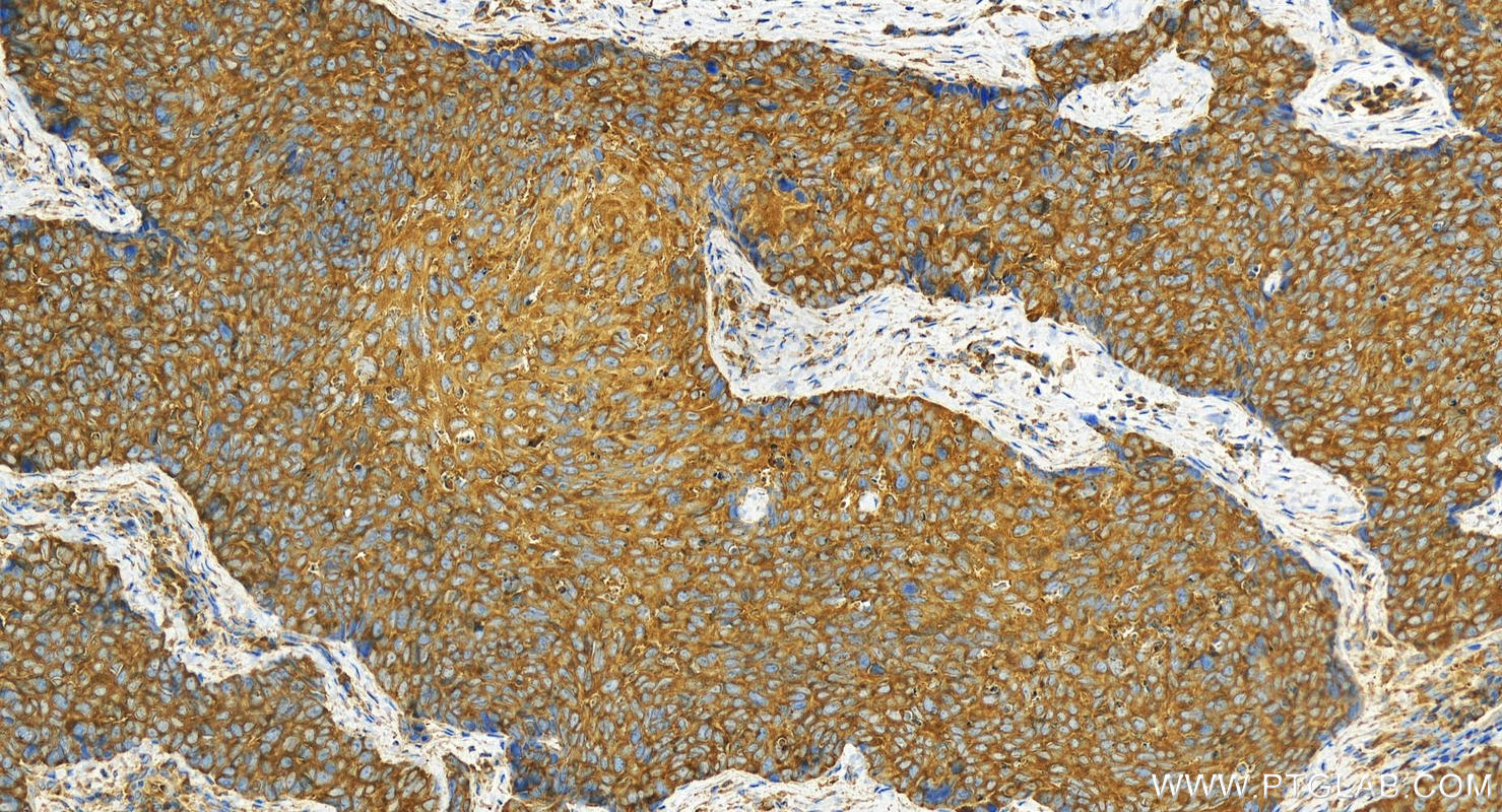 IHC staining of human brown disease using 14951-1-AP