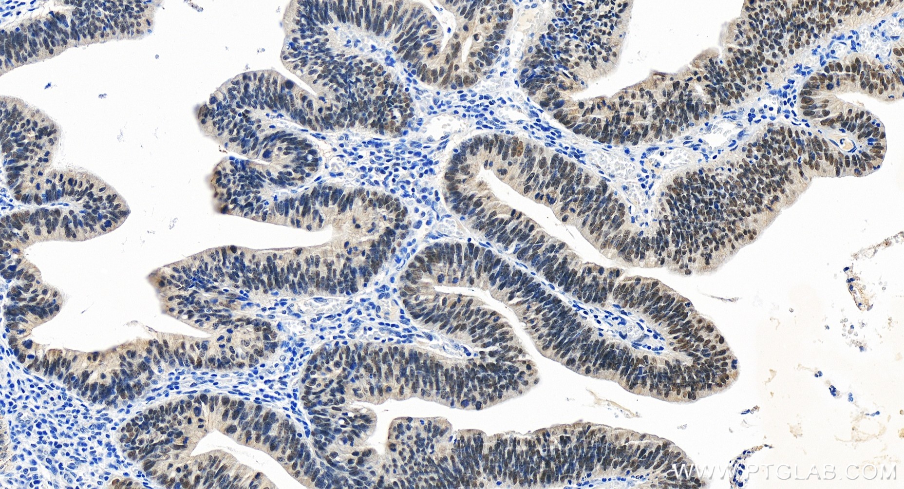 IHC staining of human colon cancer using 84669-2-RR