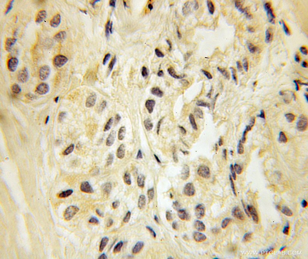 IHC staining of human prostate cancer using 10827-1-AP