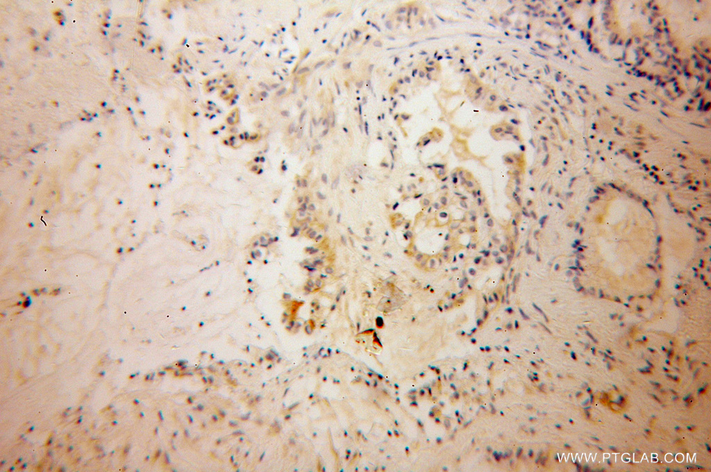 IHC staining of human pancreas cancer using 13191-1-AP