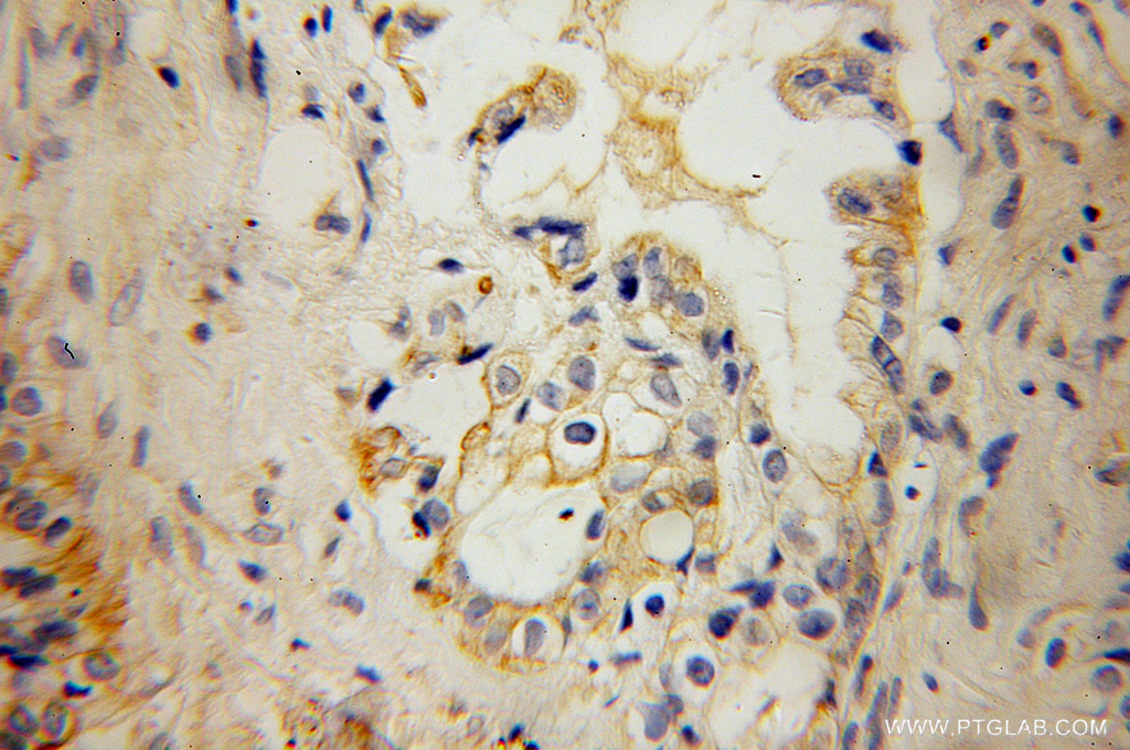 IHC staining of human pancreas cancer using 13191-1-AP