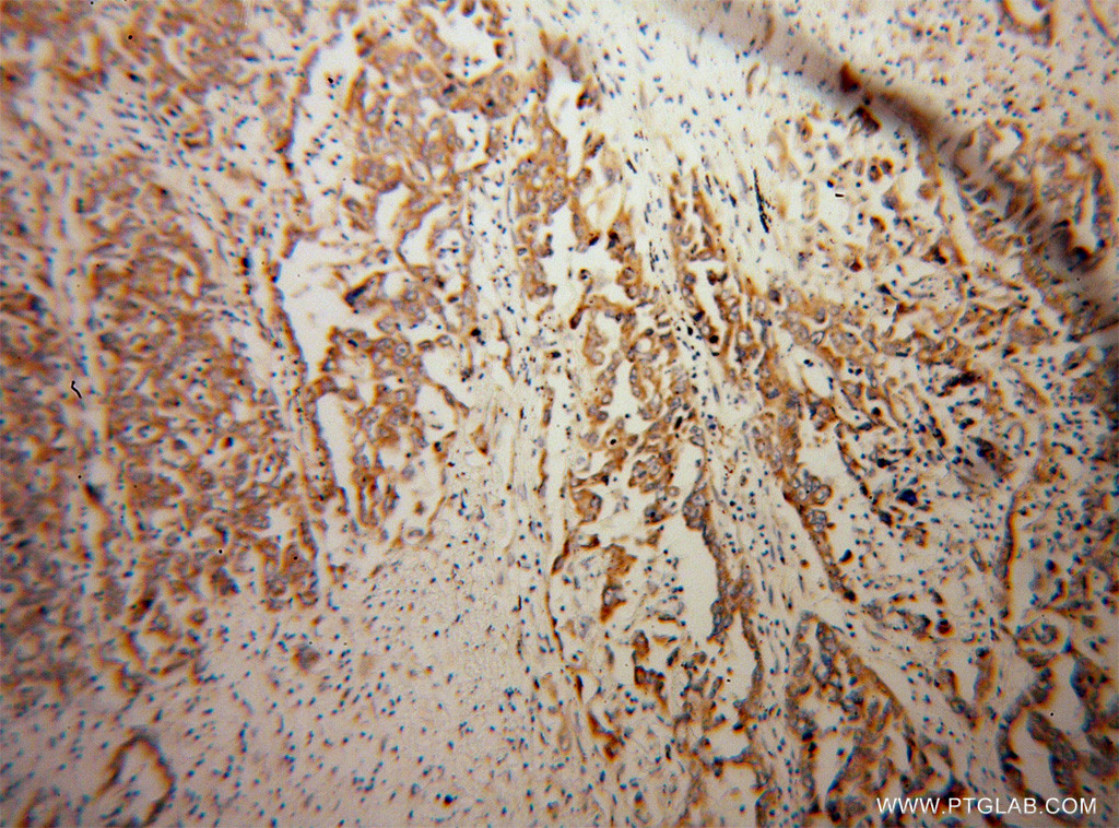 IHC staining of human pancreas cancer using 14212-1-AP (same clone as 14212-1-PBS)