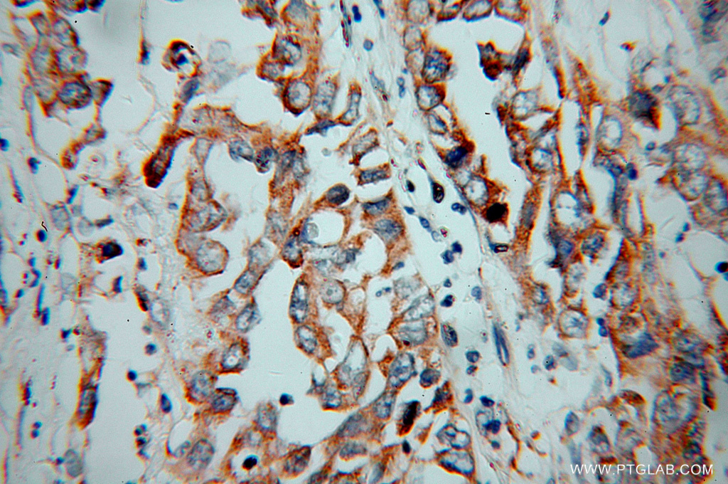 IHC staining of human pancreas cancer using 14212-1-AP (same clone as 14212-1-PBS)