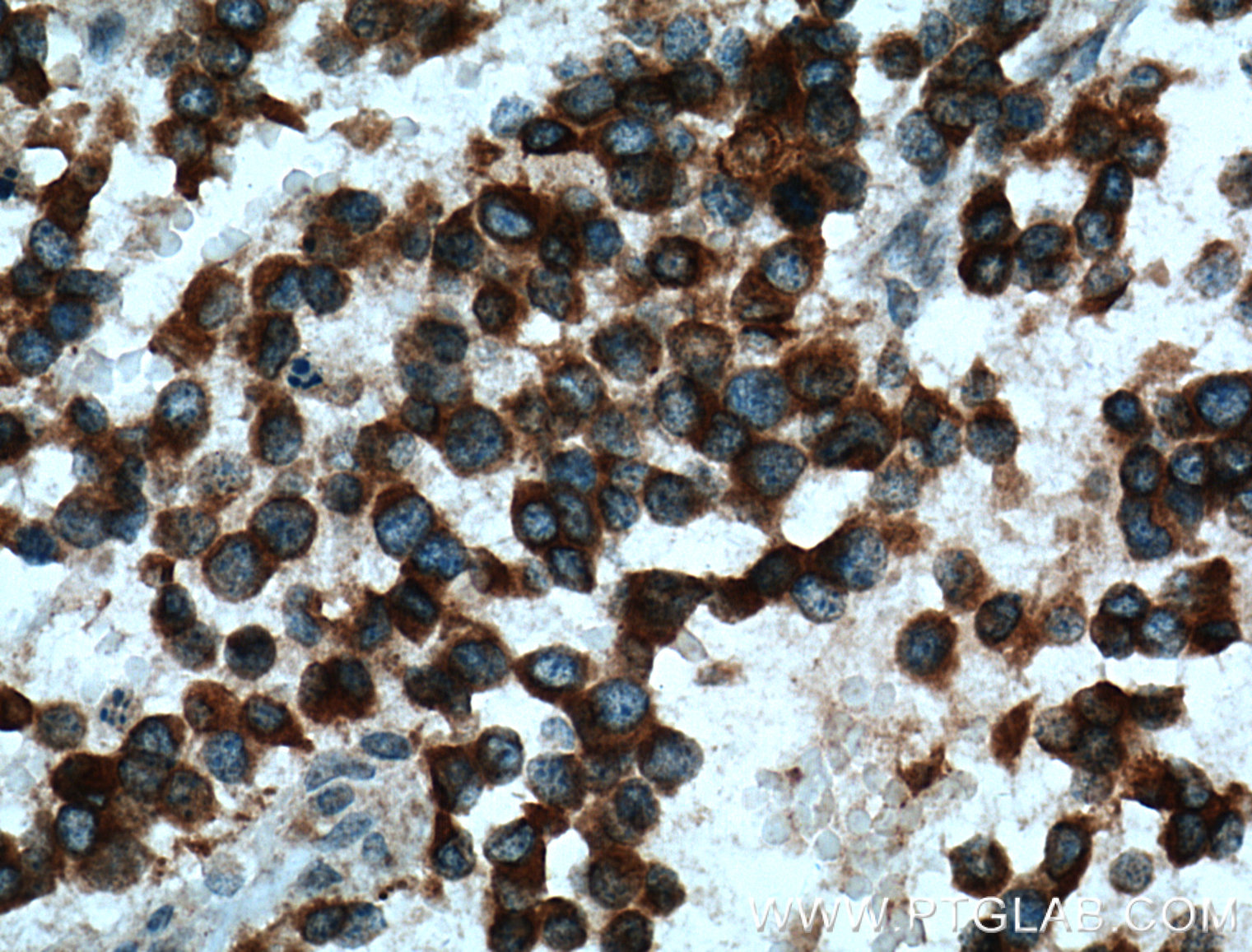 IHC staining of human gliomas using 12503-1-AP