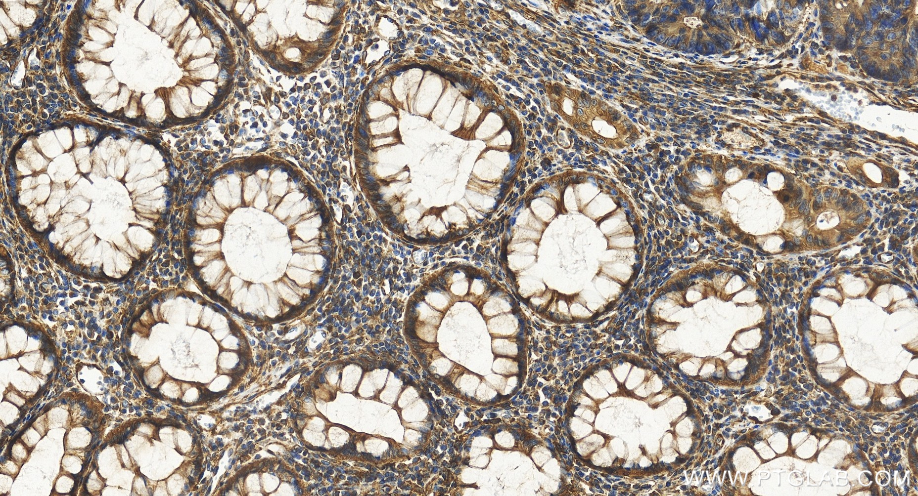 Immunohistochemical analysis of paraffin-embedded human colon cancer tissue slide using 85210-4-RR (KCTD5 antibody) at dilution of 1:500 (under 20x lens). Heat mediated antigen retrieval with Tris-EDTA buffer (pH 9.0). IHC staining of human colon cancer using 85210-4-RR