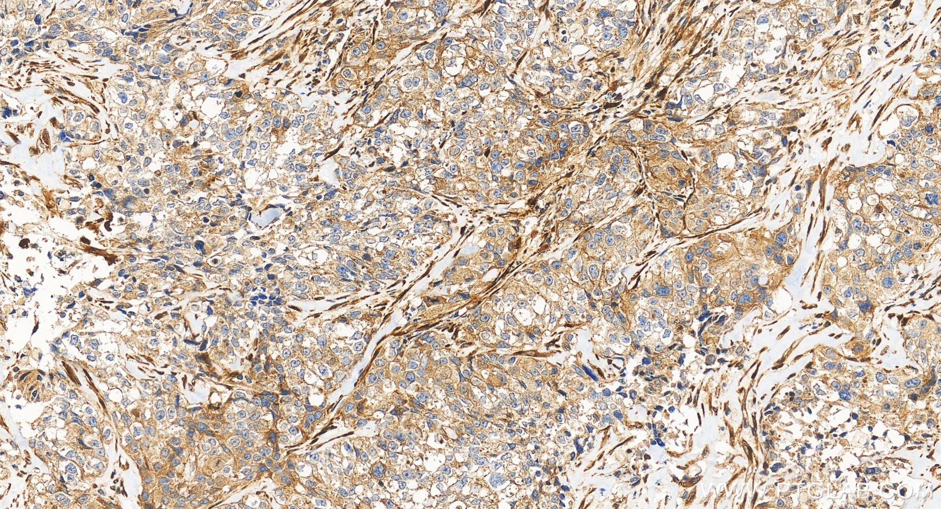 Immunohistochemical analysis of paraffin-embedded human ovary cancer tissue slide using 85210-4-RR (KCTD5 antibody) at dilution of 1:500 (under 20x lens). Heat mediated antigen retrieval with Tris-EDTA buffer (pH 9.0). IHC staining of human ovary cancer using 85210-4-RR