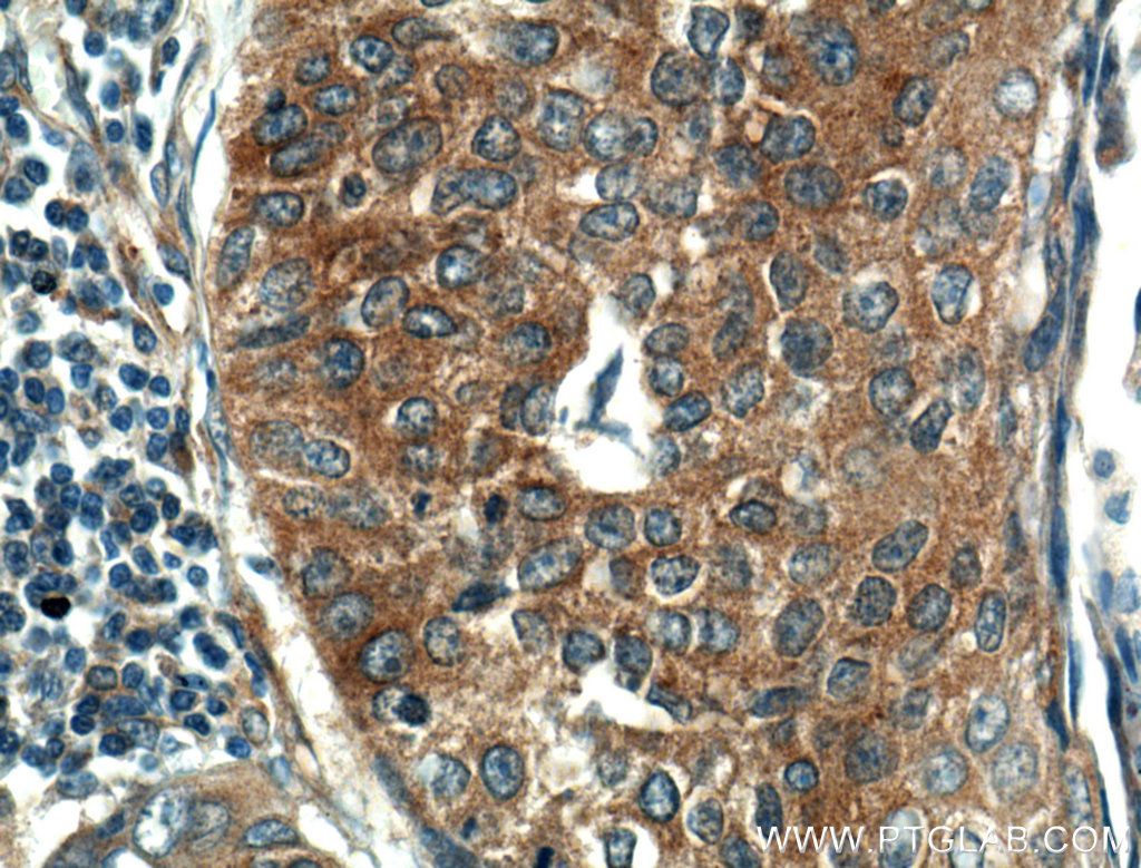 IHC staining of human lung cancer using 10503-2-AP