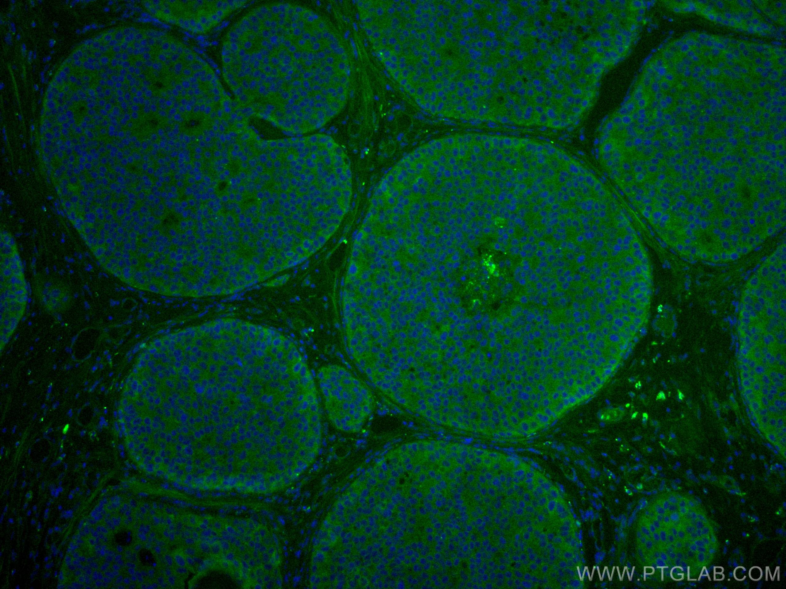 IF Staining of human breast cancer using CL488-10503