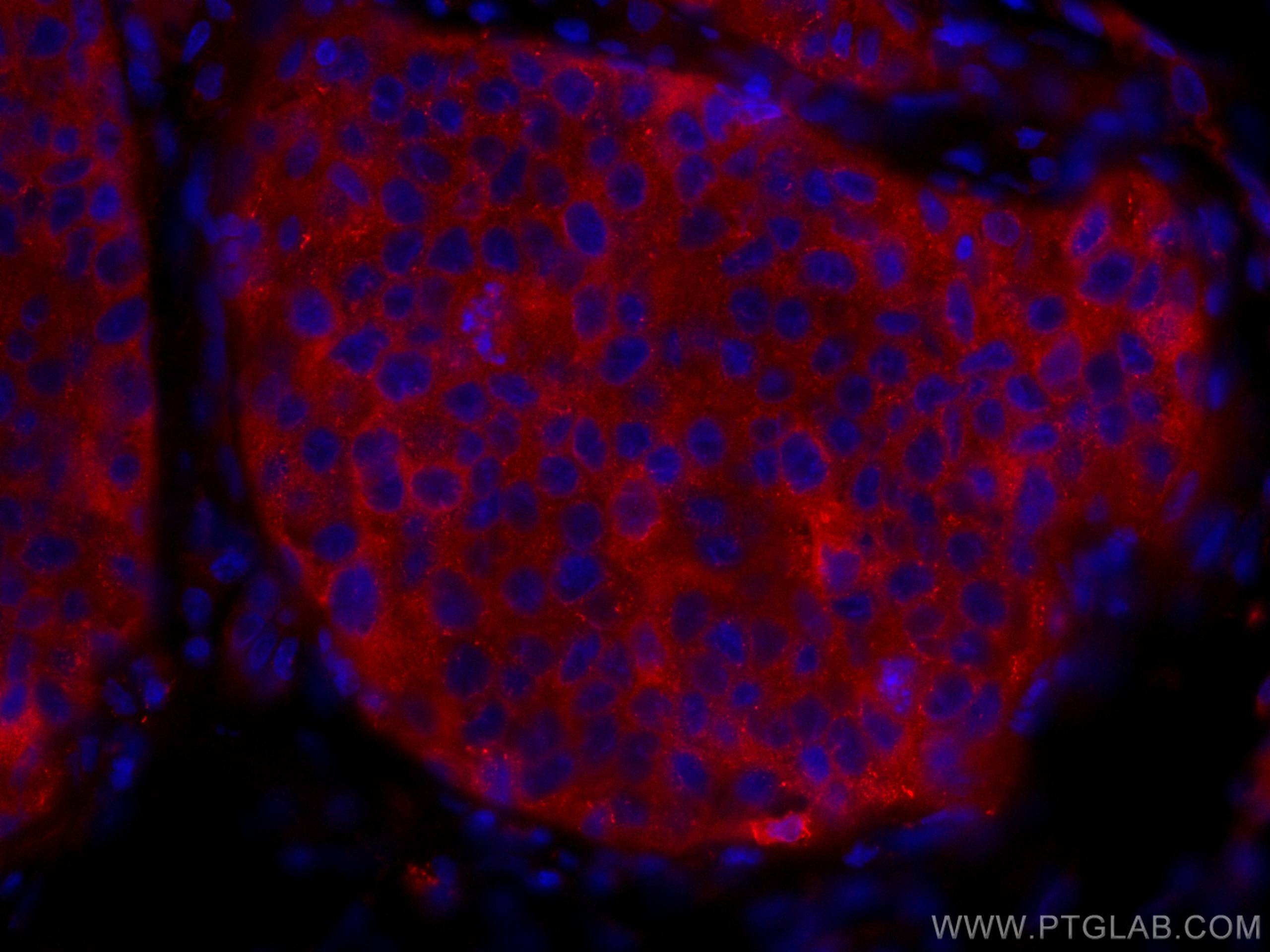 IF Staining of human breast cancer using CL594-10503