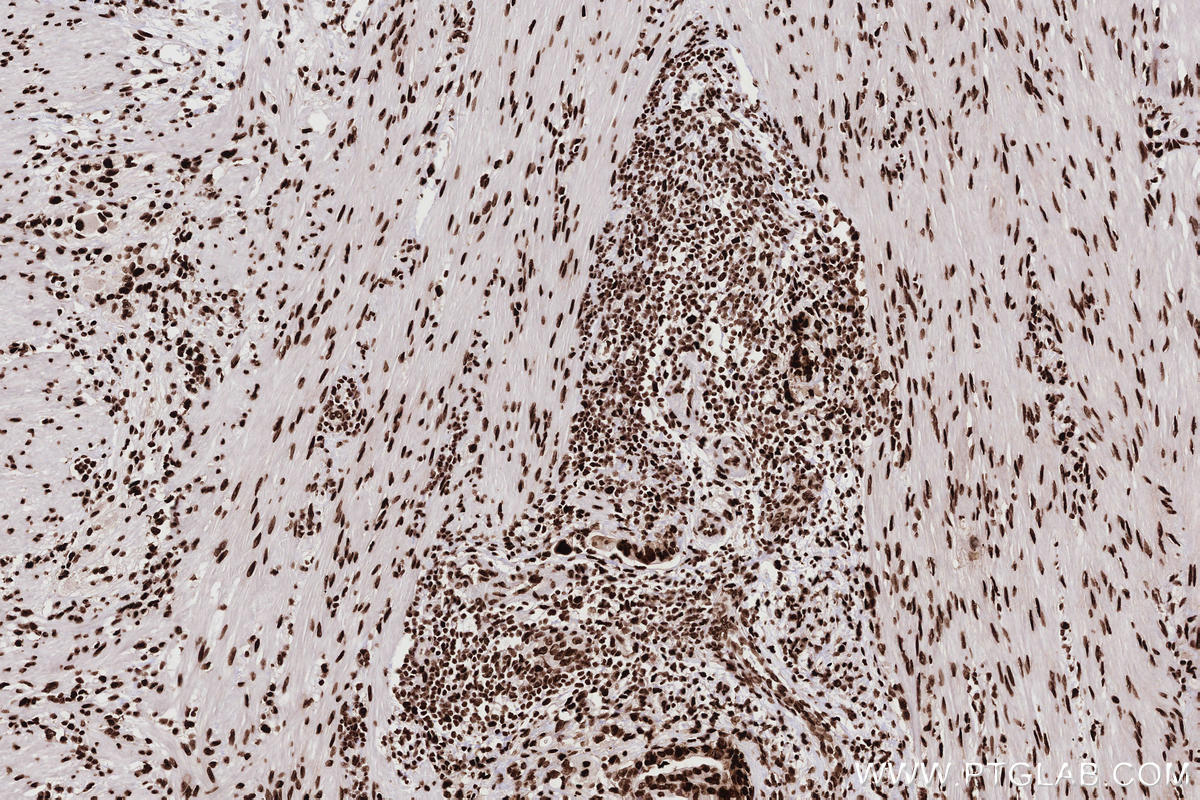 IHC staining of human rectal cancer using 82931-5-RR IHC staining of human rectal cancer using 82931-5-RR