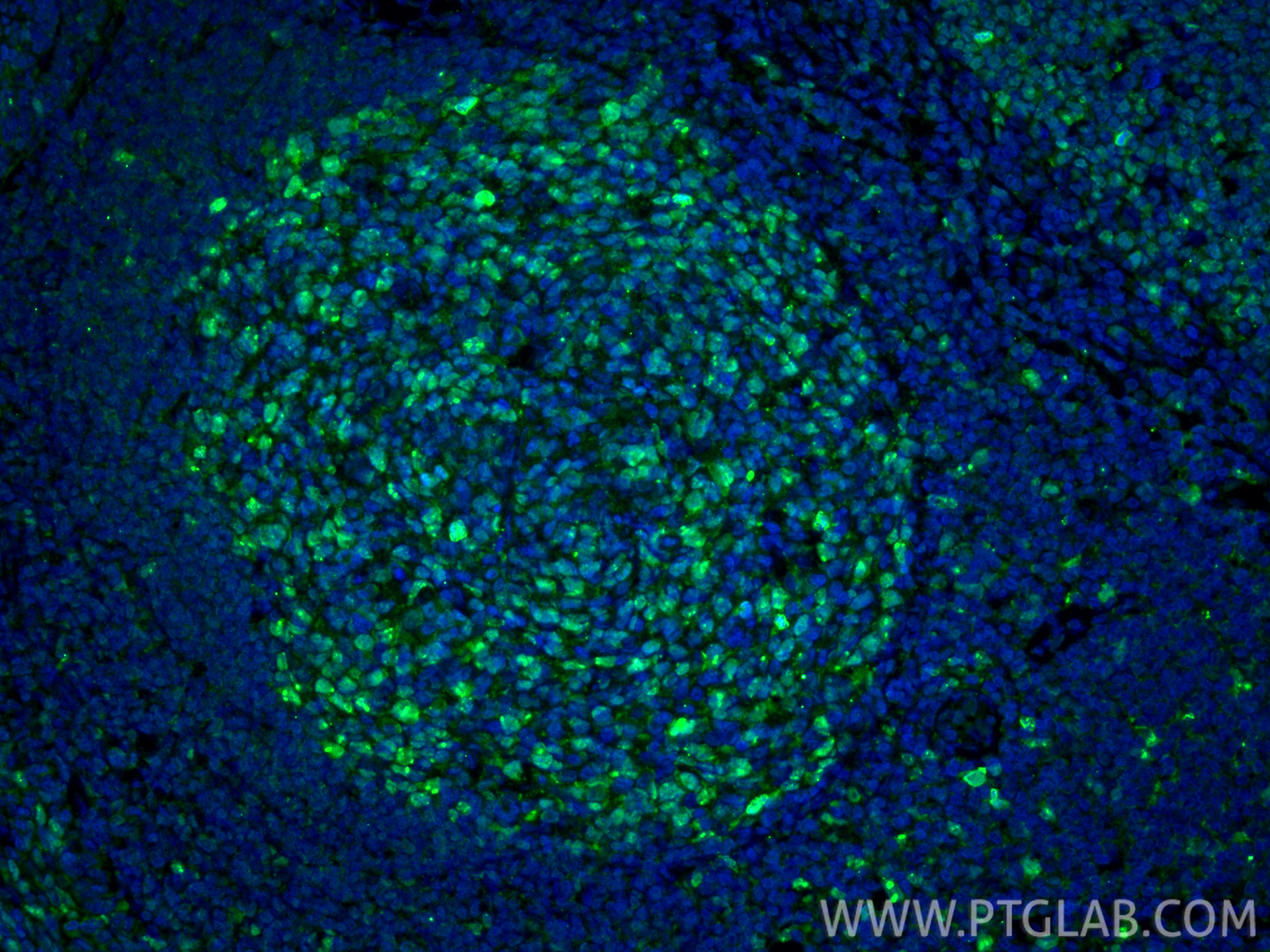 IF Staining of human tonsillitis using 27309-1-AP IF Staining of human tonsillitis using 27309-1-AP