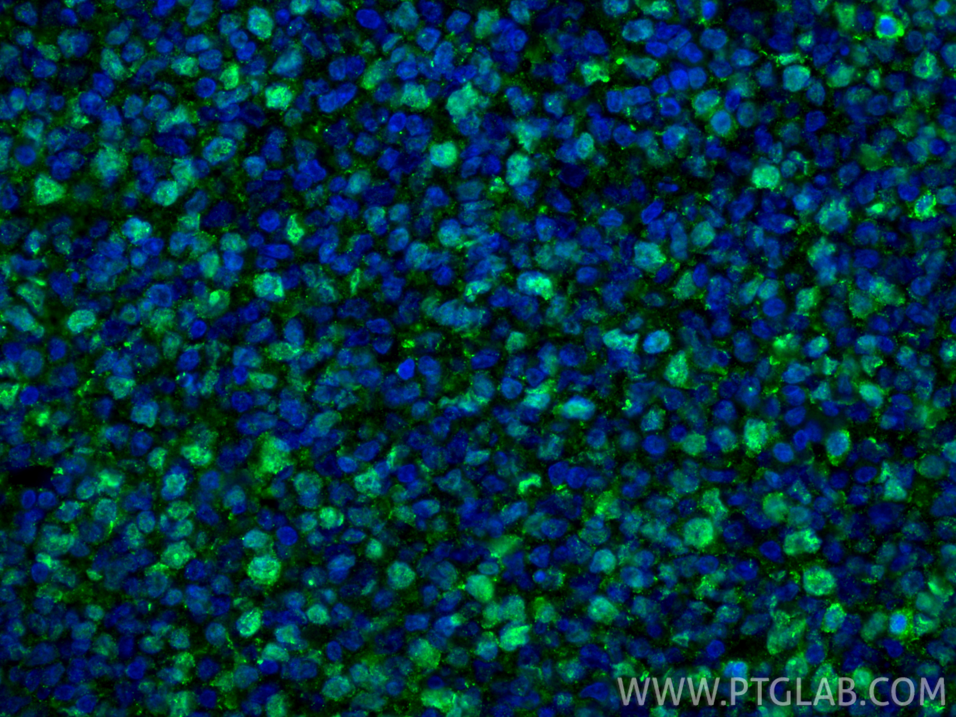 IF Staining of human tonsillitis using 27309-1-AP IF Staining of human tonsillitis using 27309-1-AP