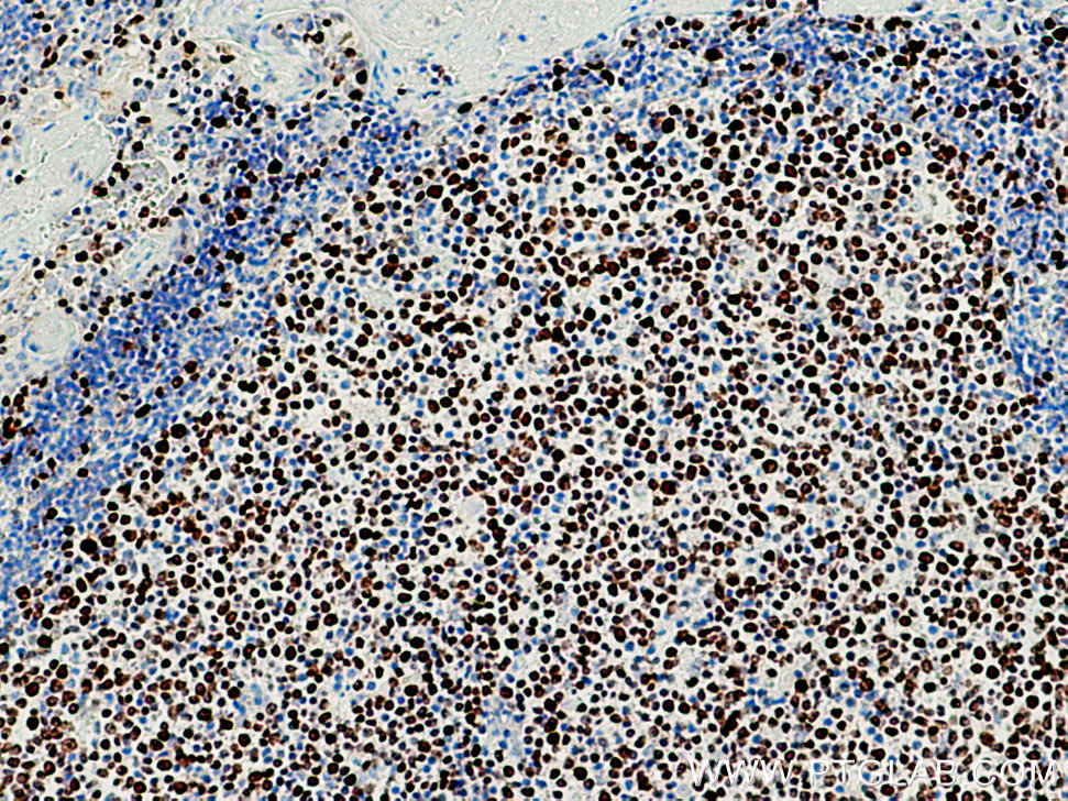 IHC staining of human tonsillitis using 27309-1-AP