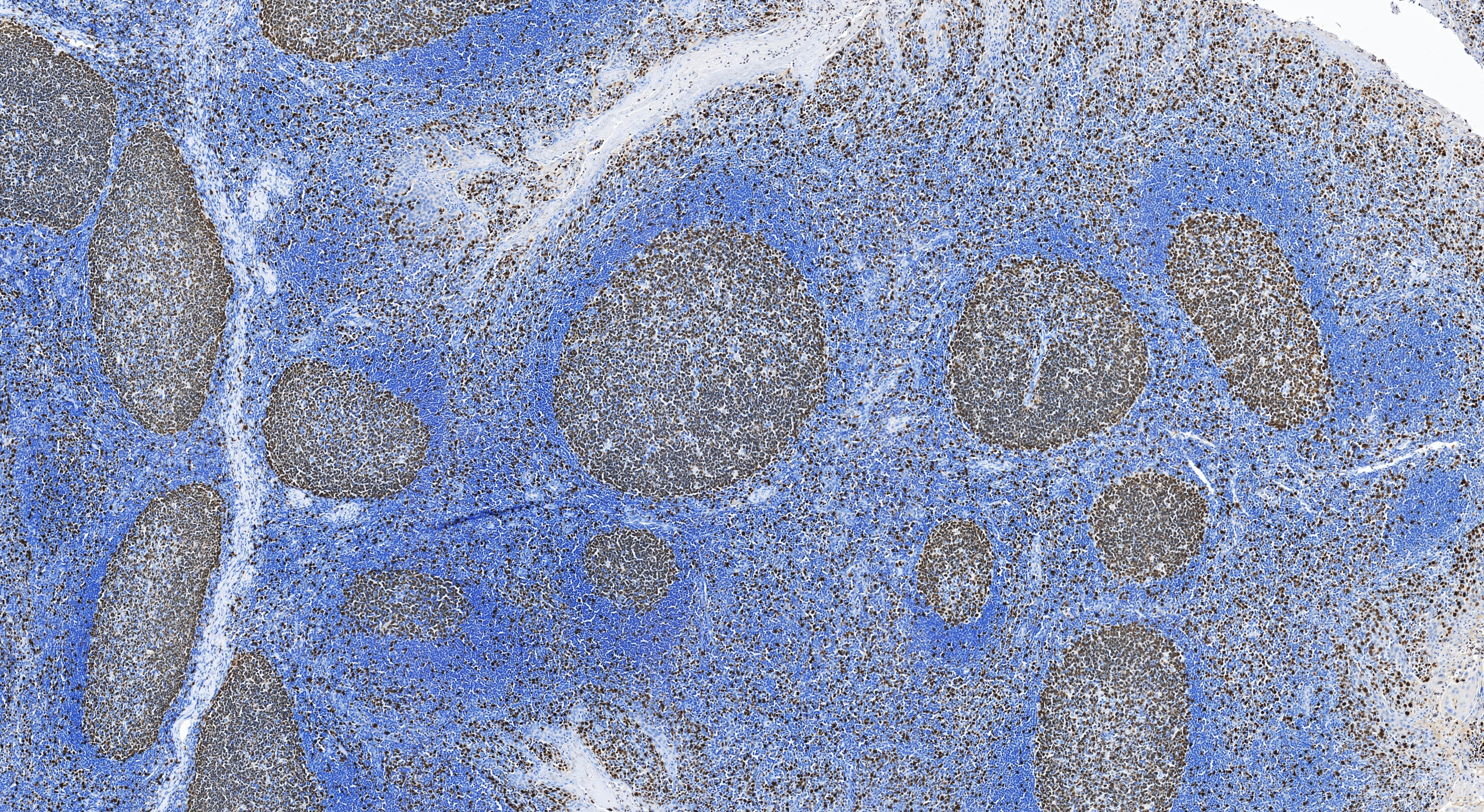 IHC staining of human tonsillitis using 84192-3-RR