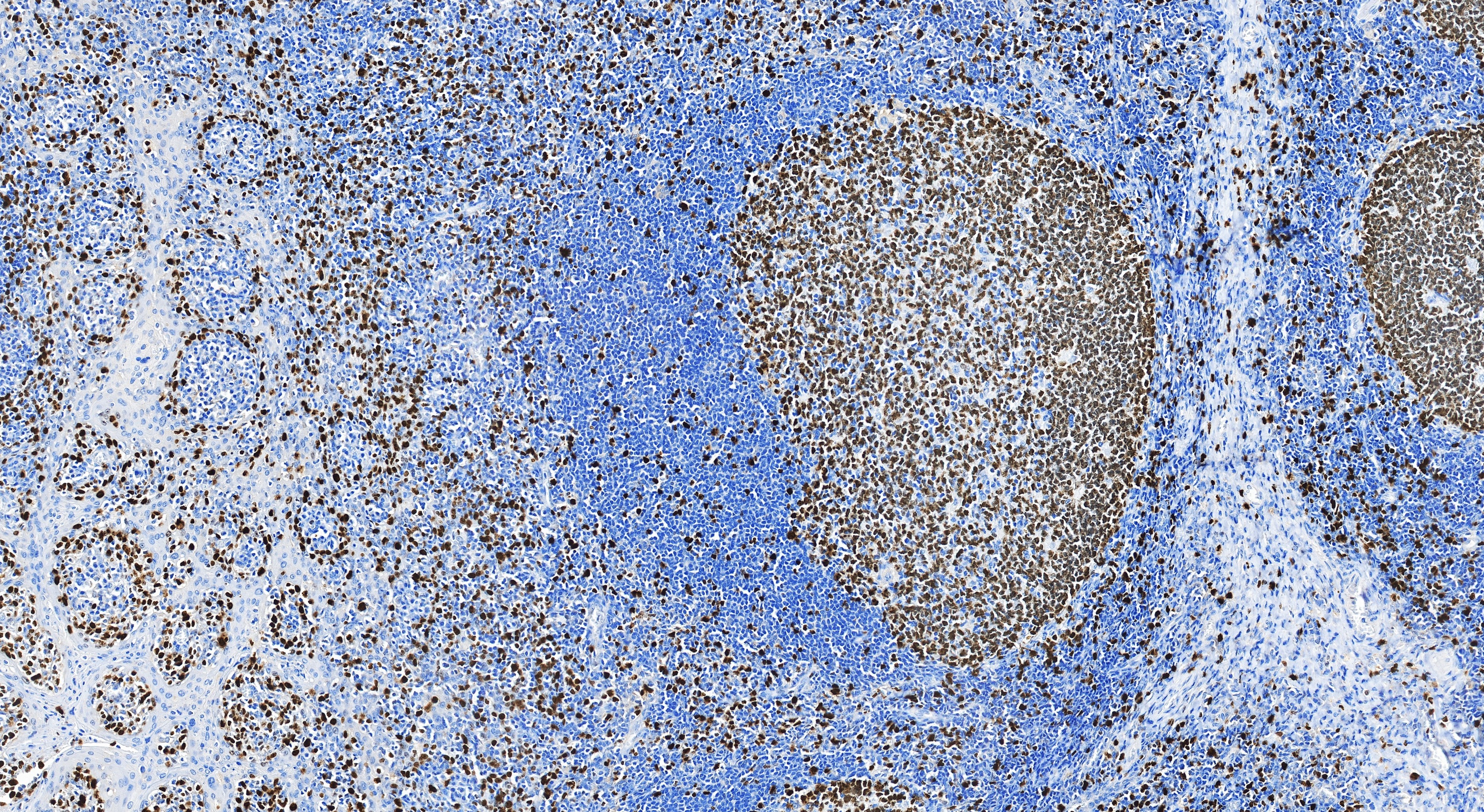 IHC staining of human tonsillitis using 84192-3-RR