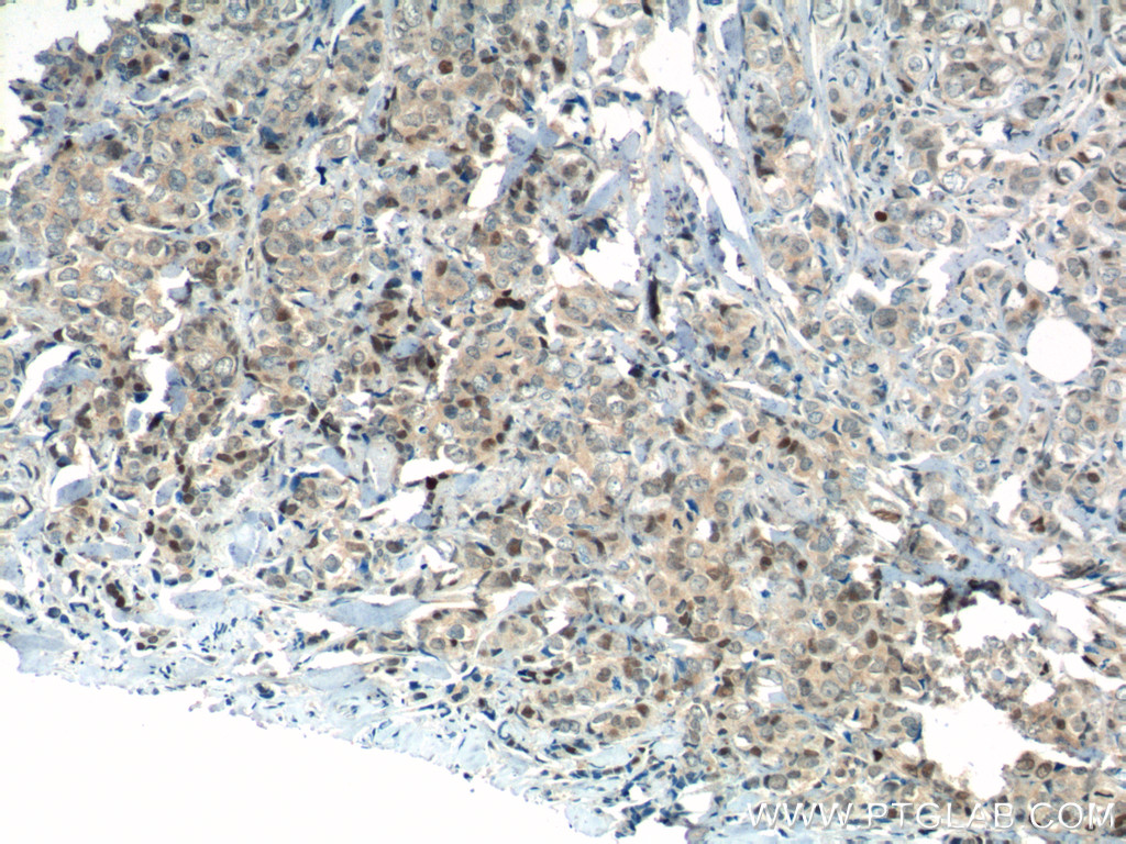 IHC staining of human breast cancer using 19972-1-AP