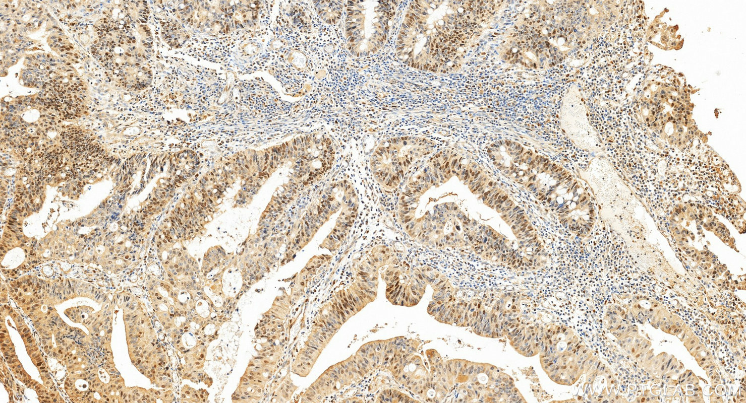 IHC staining of human colon cancer using 20537-1-AP IHC staining of human colon cancer using 20537-1-AP