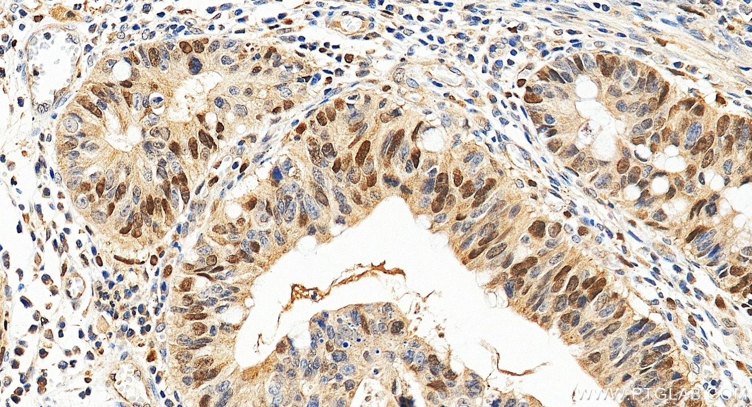 IHC staining of human colon cancer using 20537-1-AP IHC staining of human colon cancer using 20537-1-AP