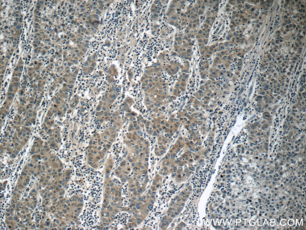 Immunohistochemical analysis of paraffin-embedded human liver cancer tissue slide using 25195-1-AP (<a class='green' href='/productredirect?CatalogNo=KIAA0125' target='_blank'>KIAA0125</a> antibody at dilution of 1:50 (under 10x lens). IHC staining of human liver cancer using 25195-1-AP