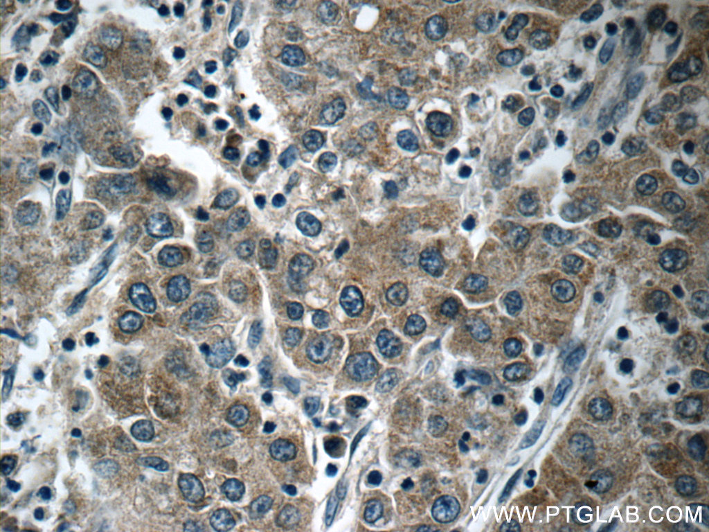 Immunohistochemical analysis of paraffin-embedded human liver cancer tissue slide using 25195-1-AP (<a class='green' href='/productredirect?CatalogNo=KIAA0125' target='_blank'>KIAA0125</a> antibody at dilution of 1:50 (under 40x lens). IHC staining of human liver cancer using 25195-1-AP