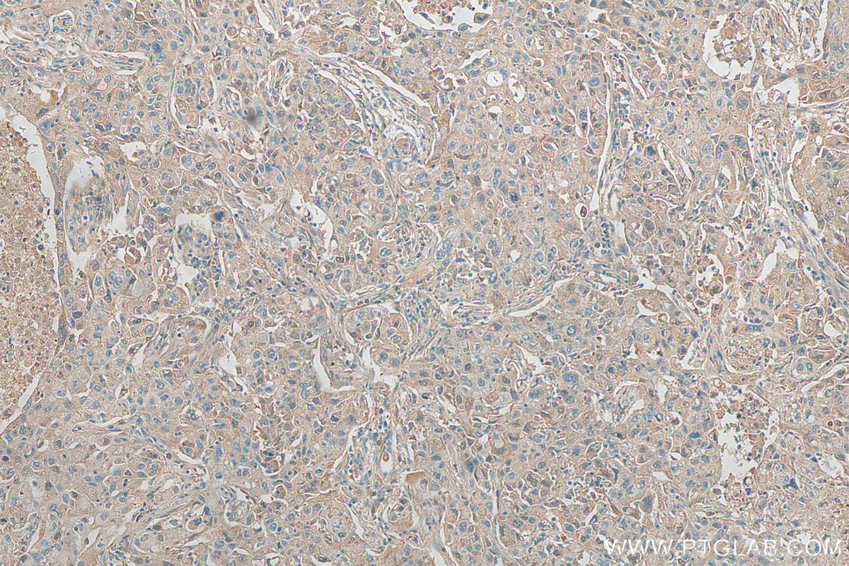 IHC staining of human lung cancer using 25419-1-AP