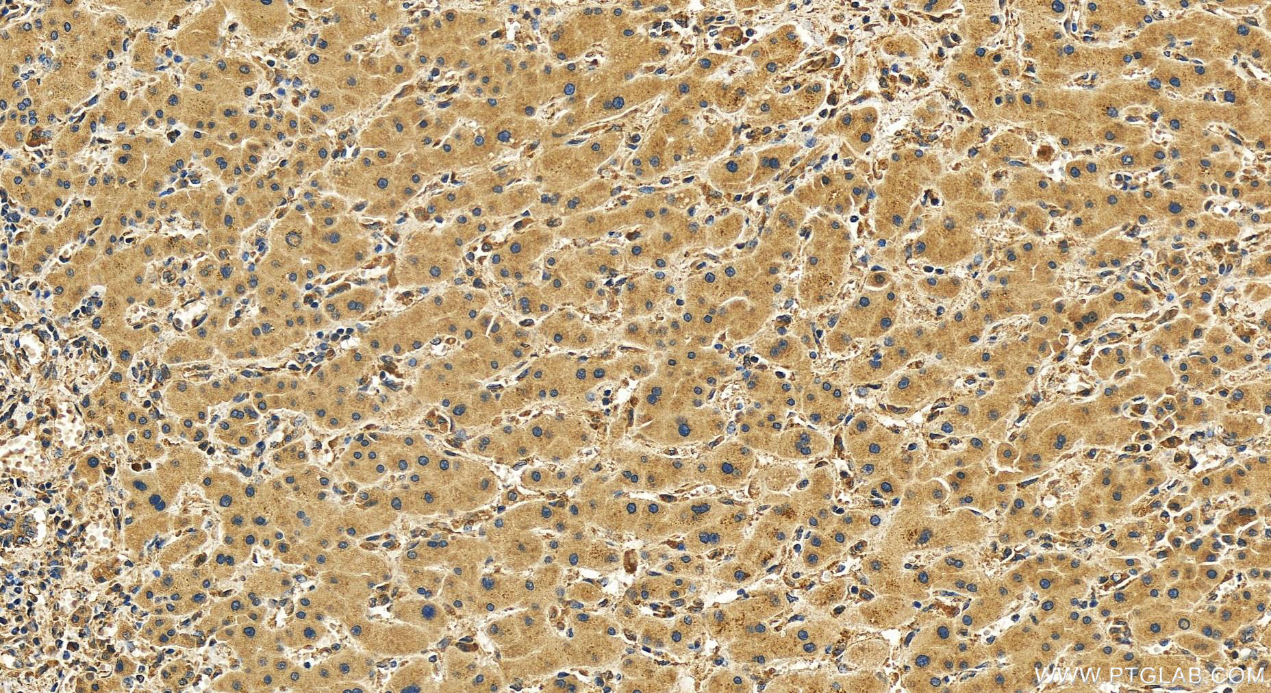 IHC staining of human intrahepatic cholangiocarcinoma using 51101-1-AP