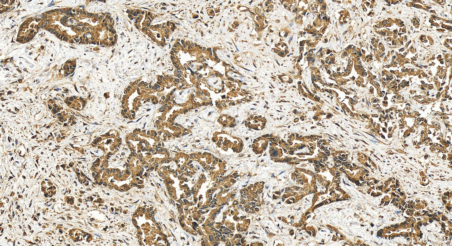IHC staining of human intrahepatic cholangiocarcinoma using 51101-1-AP