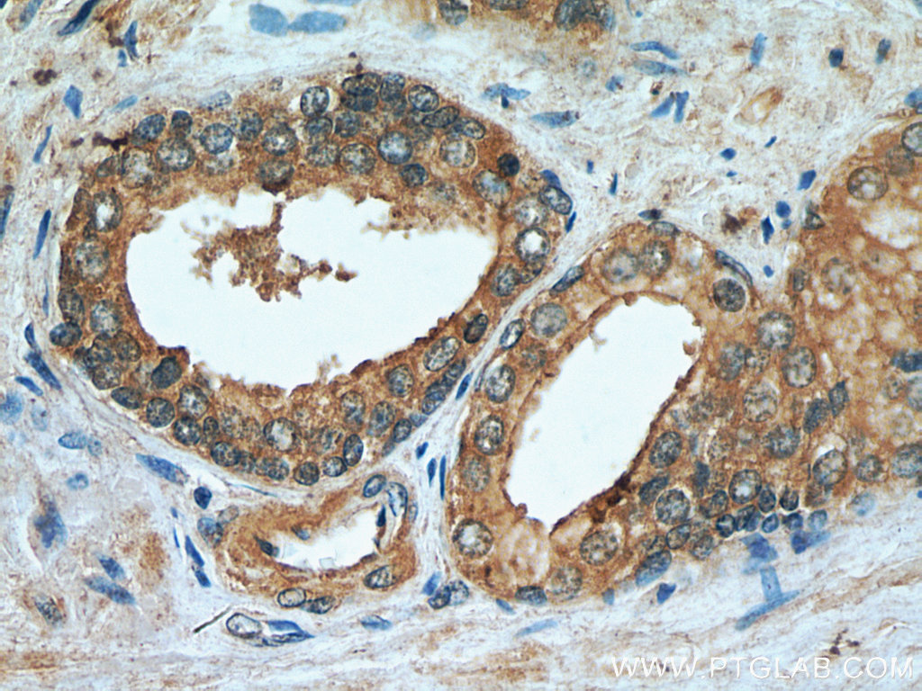 IHC staining of human prostate hyperplasia using 21129-1-AP