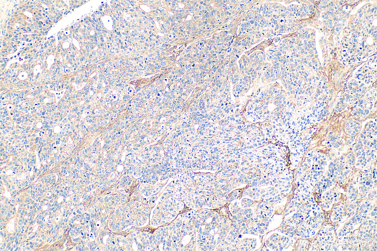 IHC staining of human ovary tumor using 21129-1-AP