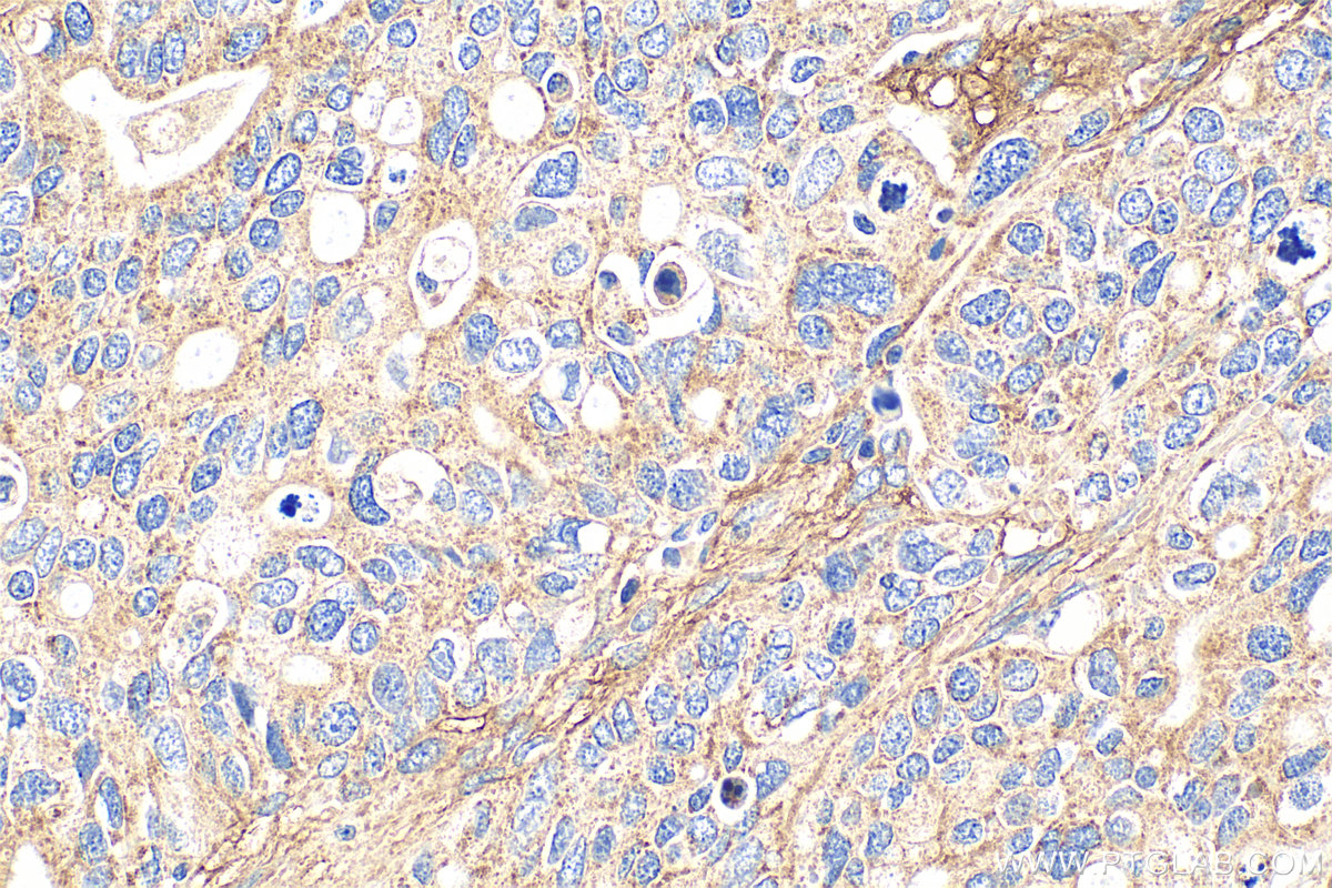 IHC staining of human ovary tumor using 21129-1-AP