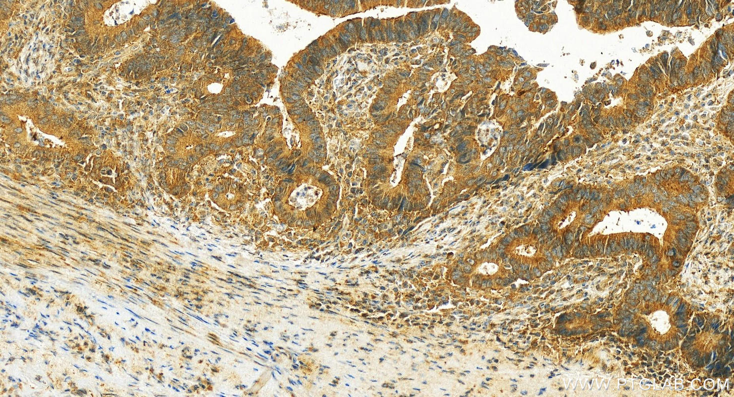 IHC staining of human colon cancer using 31106-1-AP