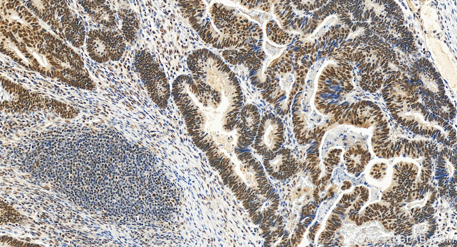 IHC staining of human colon cancer using 68235-1-Ig (same clone as 68235-1-PBS)