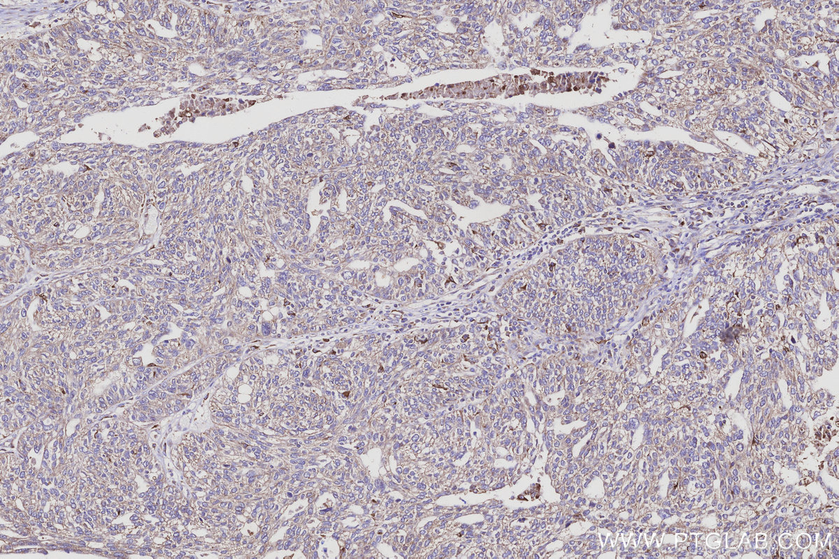 IHC staining of human ovary cancer using 18993-1-AP IHC staining of human ovary cancer using 18993-1-AP