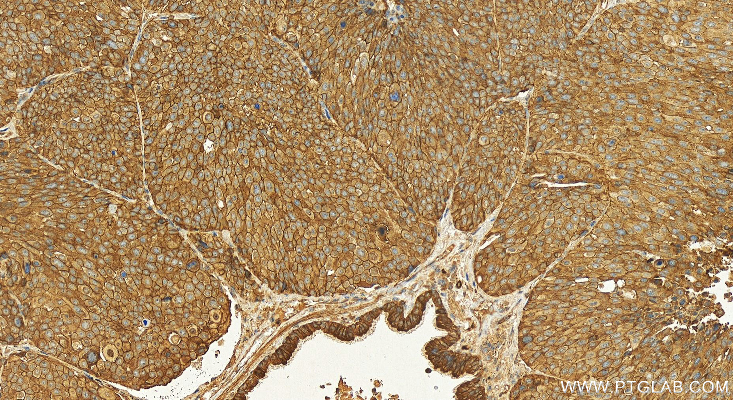 IHC staining of human lung squamous cell carcinoma using 31198-1-AP