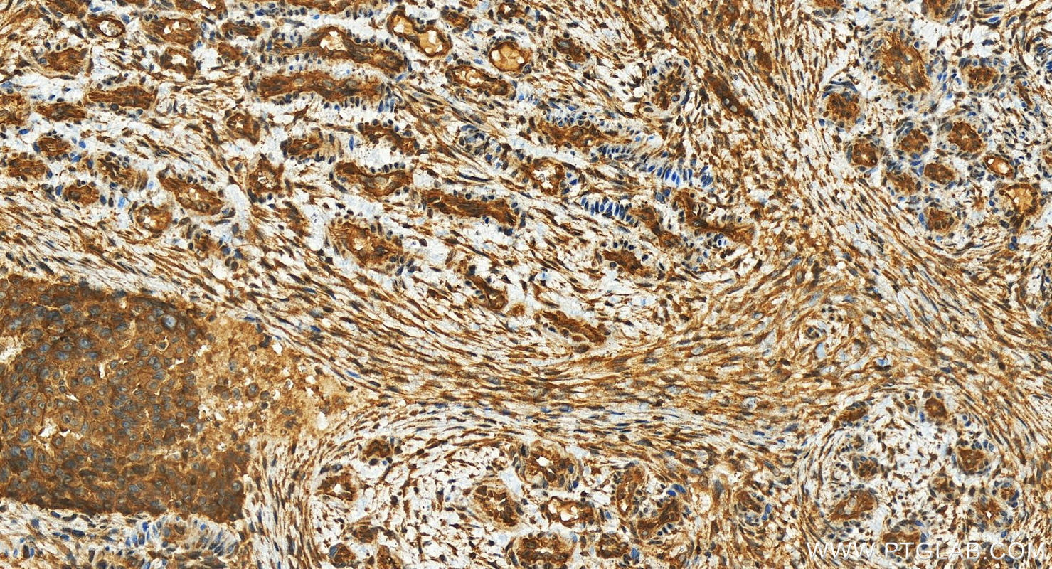 Immunohistochemical analysis of paraffin-embedded human ovarian cancer slide using 21856-1-AP (KIDINS220 antibody) at dilution of 1:400 (under 20x lens). Heat mediated antigen retrieval with Tris-EDTA buffer (pH 9.0). IHC staining of human ovarian cancer using 21856-1-AP