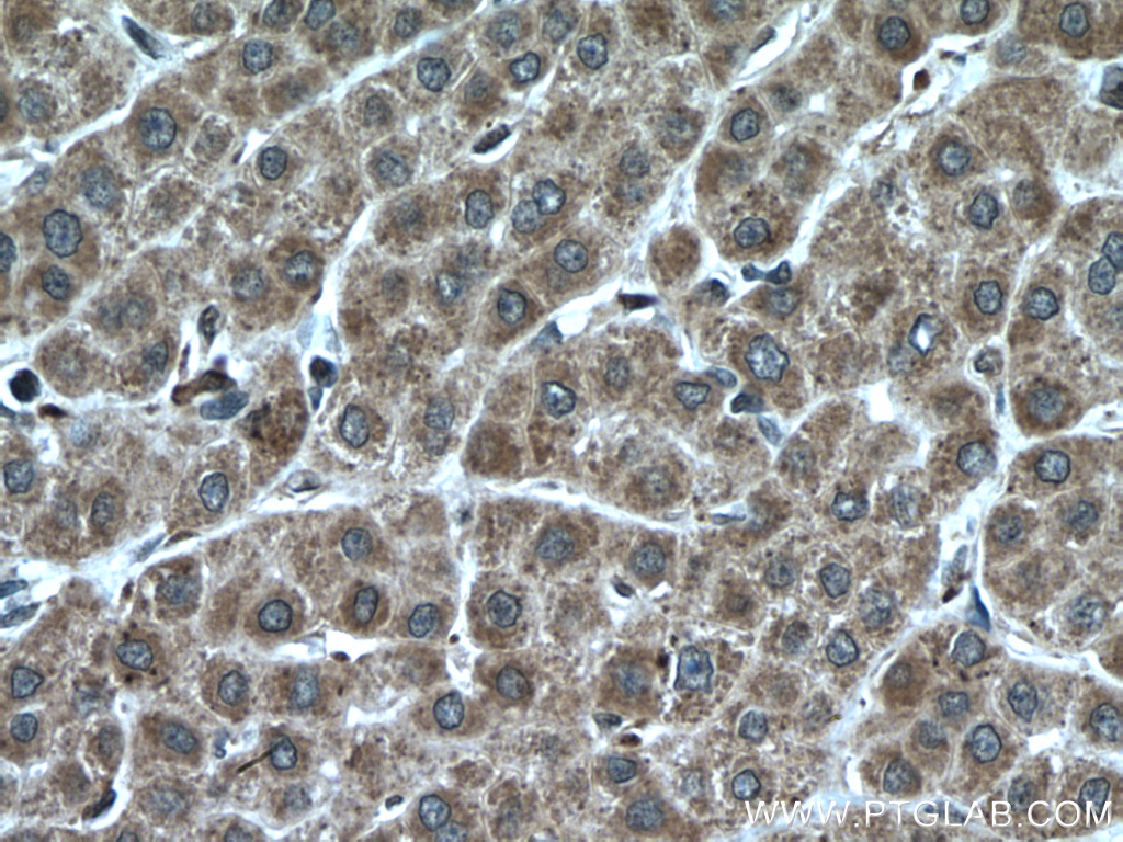 IHC staining of human liver cancer using 27210-1-AP