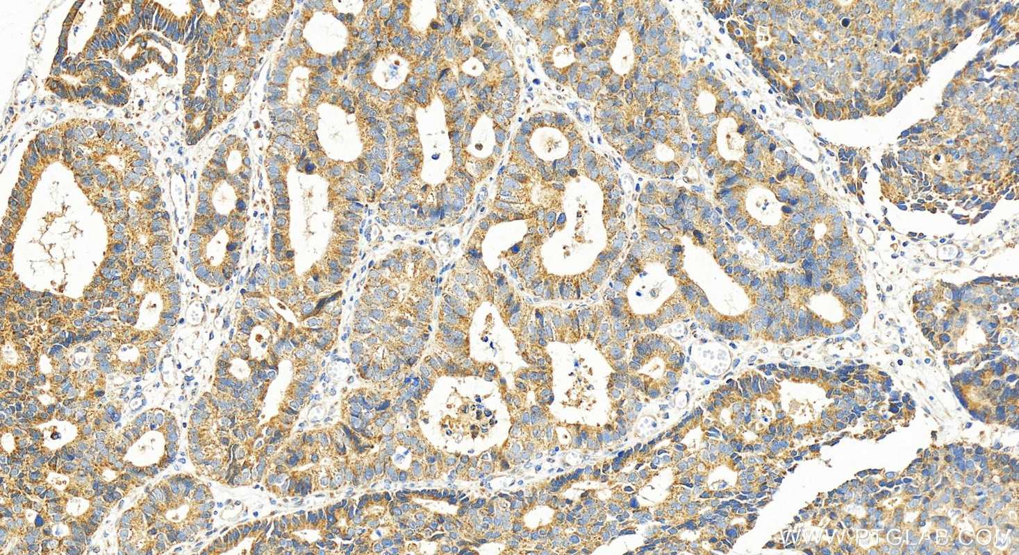 IHC staining of human stomach cancer using 30141-1-AP