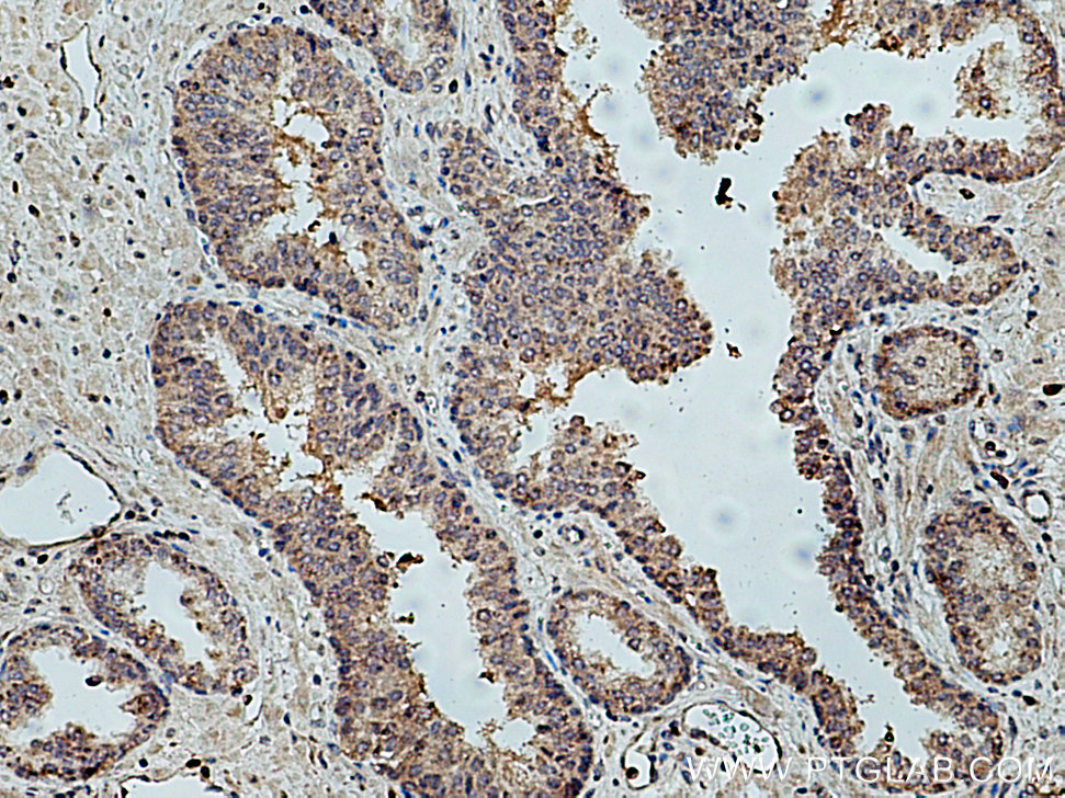 IHC staining of human prostate cancer using 26000-1-AP