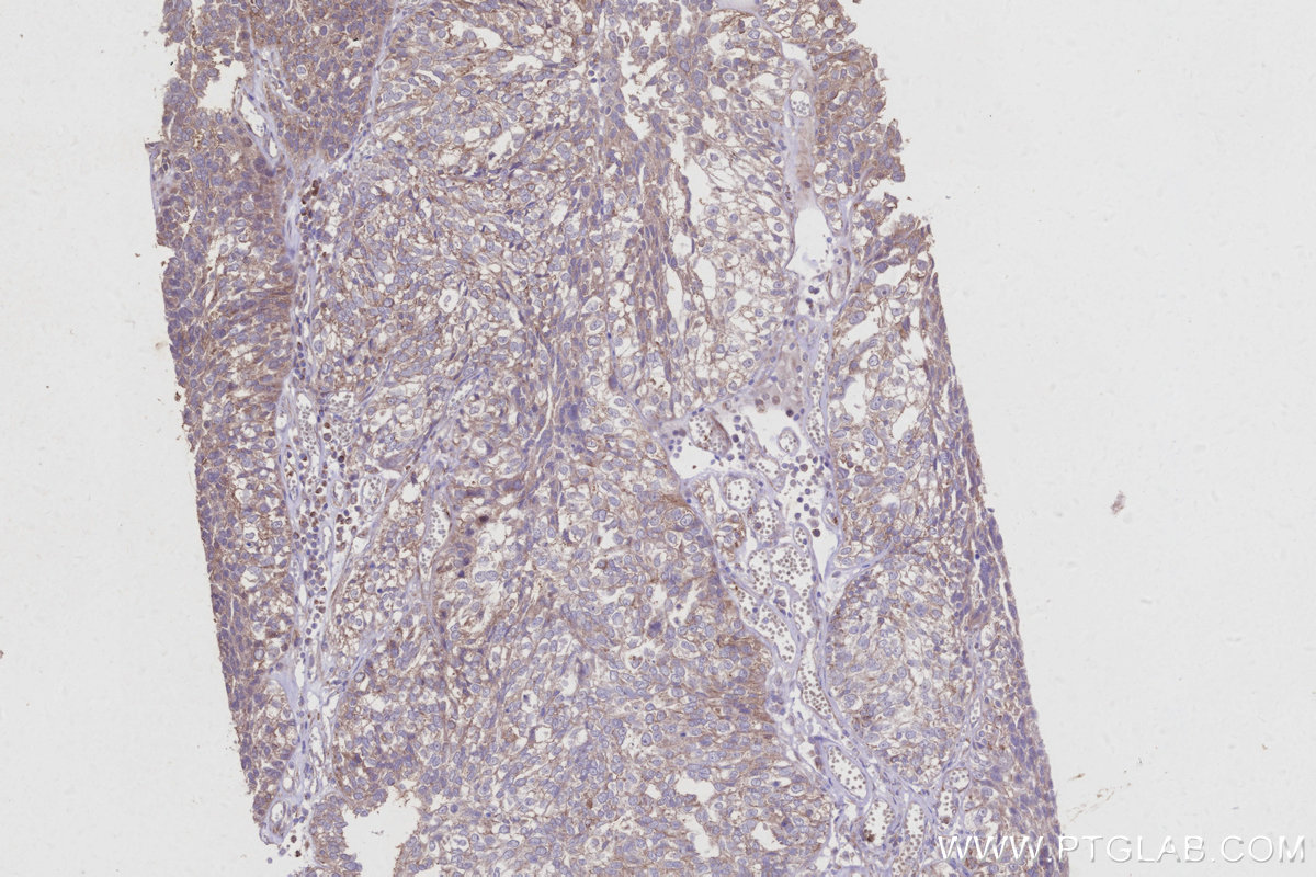 IHC staining of human ovary cancer using 30774-1-AP (same clone as 30774-1-PBS)