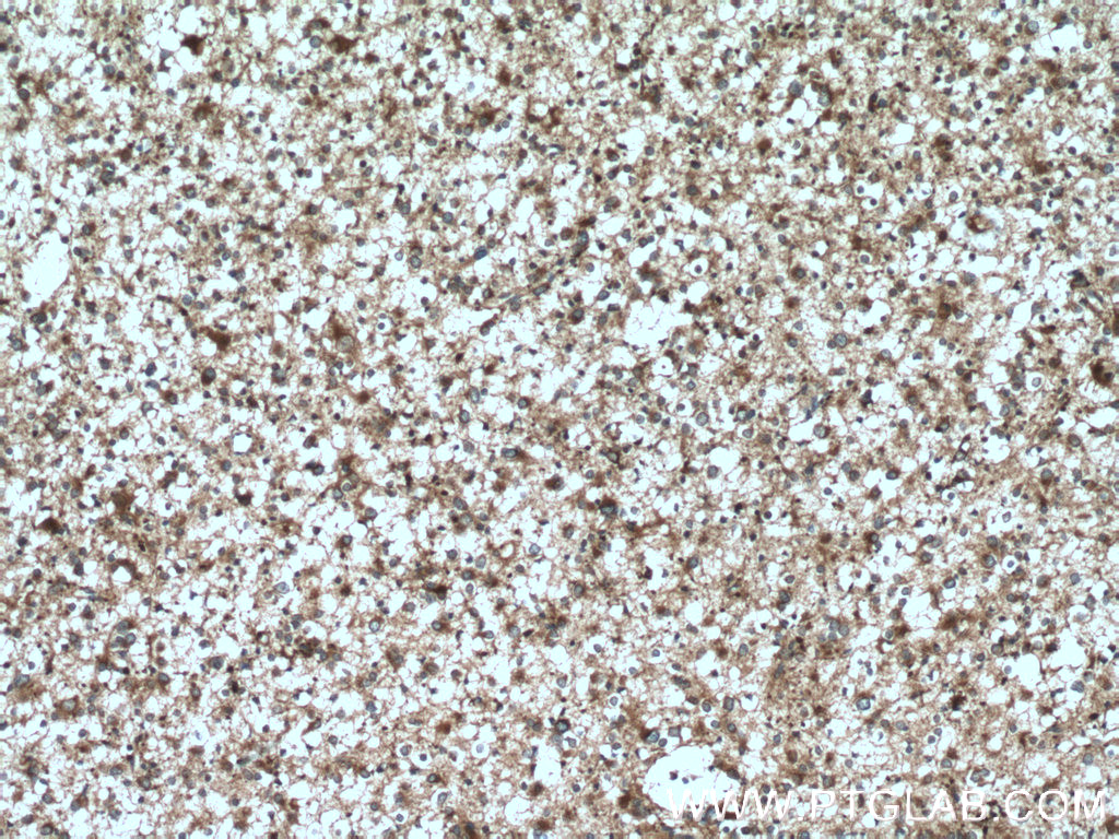 IHC staining of human gliomas using 14615-1-AP