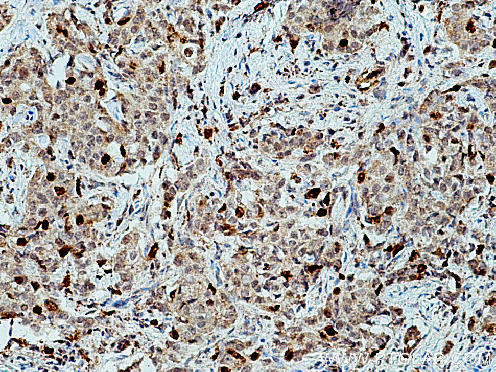 IHC staining of human breast cancer using 15911-1-AP