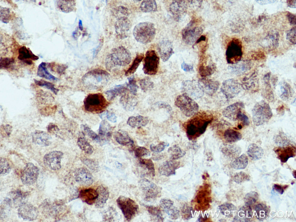 IHC staining of human breast cancer using 15911-1-AP
