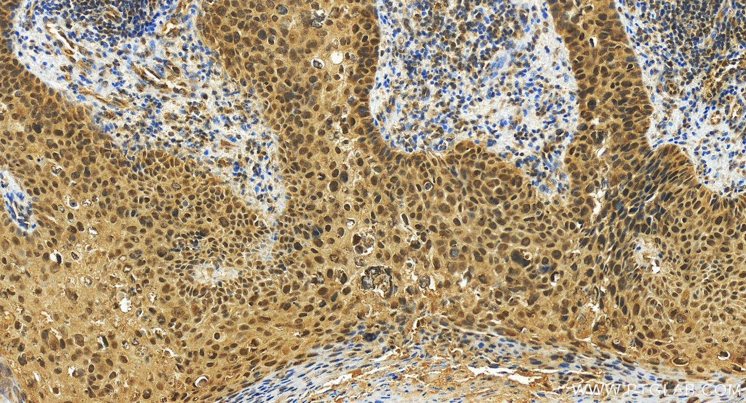 IHC staining of human brown disease using 13403-1-AP