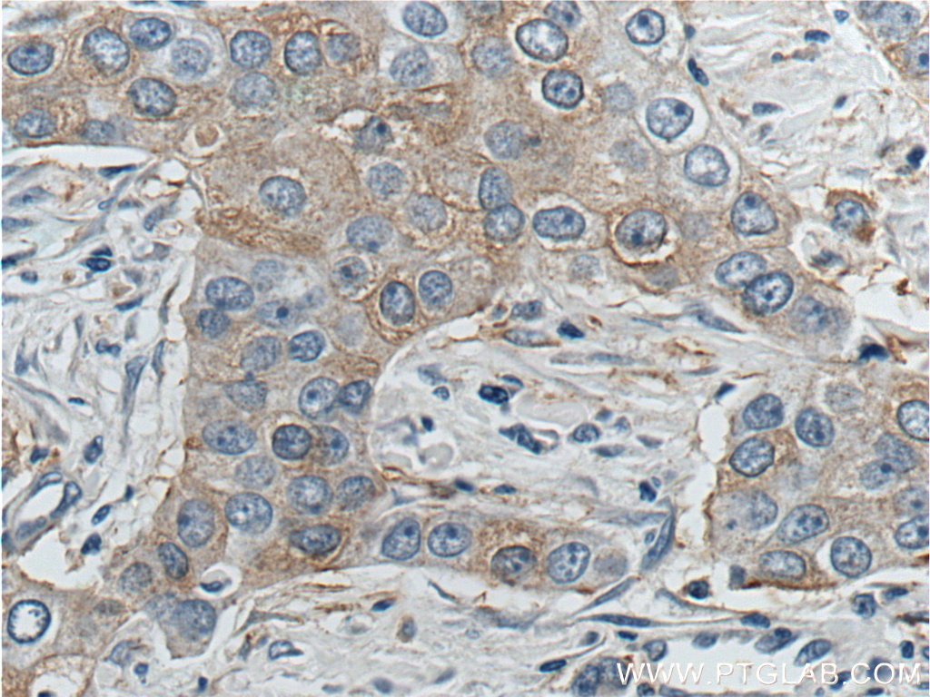 IHC staining of human breast cancer using 13105-1-AP