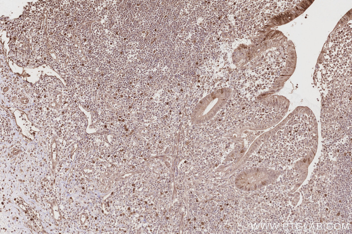 IHC staining of human appendicitis using 28372-1-AP IHC staining of human appendicitis using 28372-1-AP