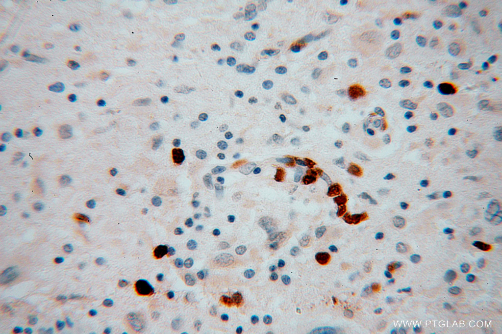 IHC staining of human gliomas using 13930-1-AP