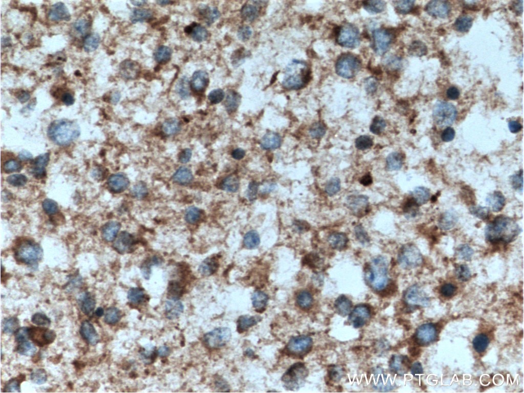 IHC staining of human gliomas using 14333-1-AP