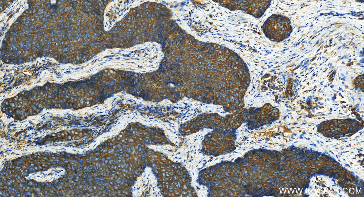 Immunohistochemical analysis of paraffin-embedded human bowen disease slide using 21632-1-AP (KIF5B antibody) at dilution of 1:1600 (under 20x lens). Heat mediated antigen retrieval with Tris-EDTA buffer (pH 9.0). IHC staining of human bowen disease using 21632-1-AP