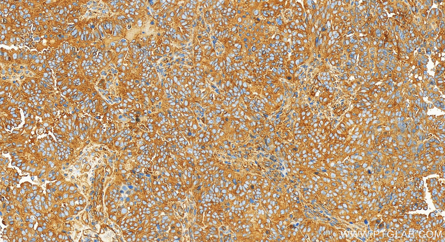 IHC staining of human ovarian  cancer using 82485-1-RR (same clone as 82485-1-PBS)